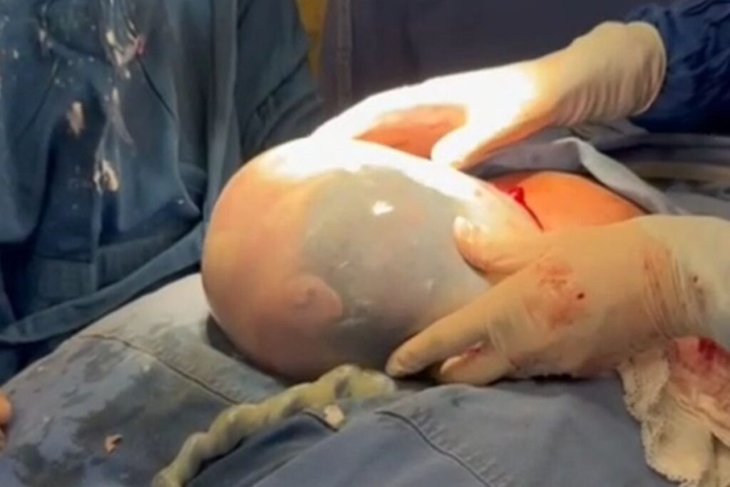 Imagem destacada do post: Gêmea nasce empelicada e surpreende médicos e familiares; veja vídeo