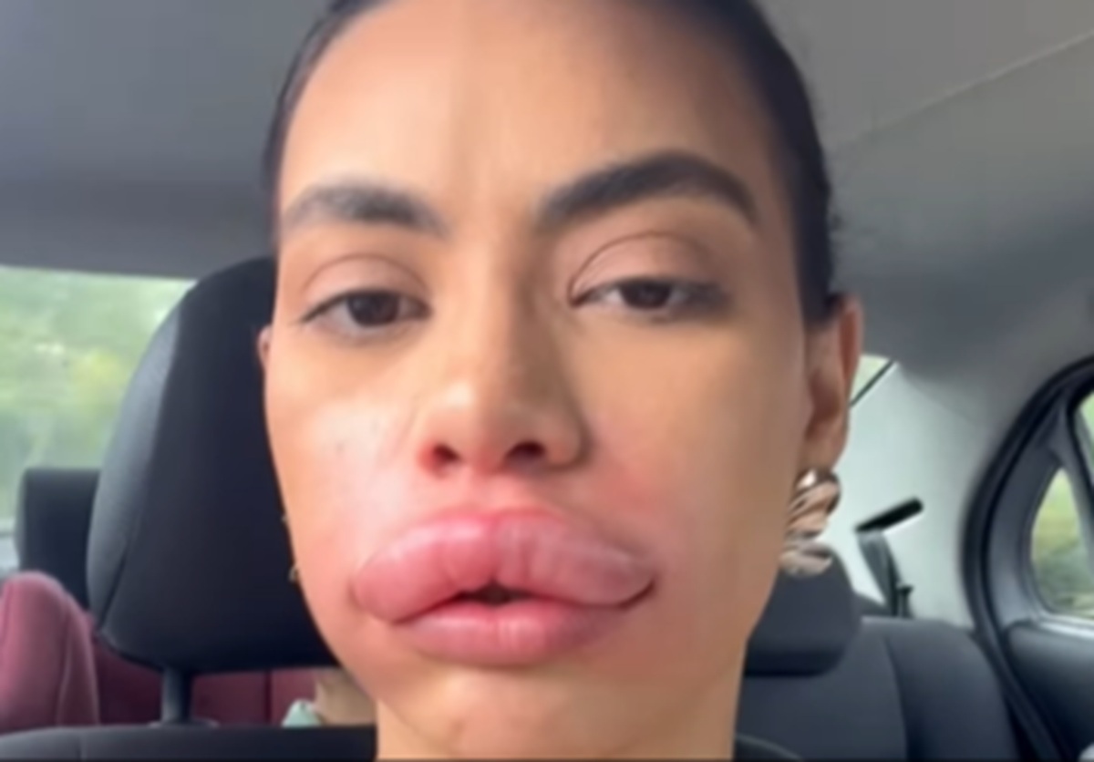 Imagem destacada do post: Mulher faz remoção de preenchimento e brinca com boca inchada; veja vídeo
