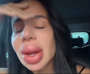 Mulher remove preenchimento labial e mostra ‘perrengue’ após procedimento [vídeo]